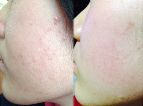 Chấm mụn bằng serum trị mụn Pizu Chấm mụn bằng serum trị mụn Pizu