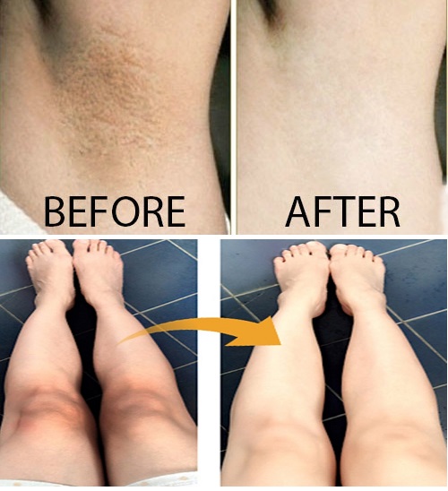 Snow White Spot Gel giúp loại bỏ các vết thâm sạm da dễ dàng