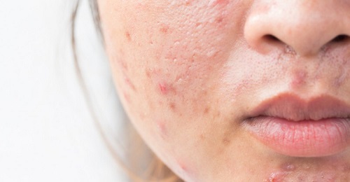 Làn da đầy mụn, vết thâm khiến bạn khó chịu, mất tự tin