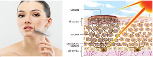 Nám da dễ xuất hiện khi chúng ta không chăm sóc da cẩn thận Nám da dễ xuất hiện khi chúng ta không chăm sóc da cẩn thận