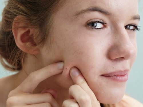 Tuyệt đối không được dùng tay nặn mụn 