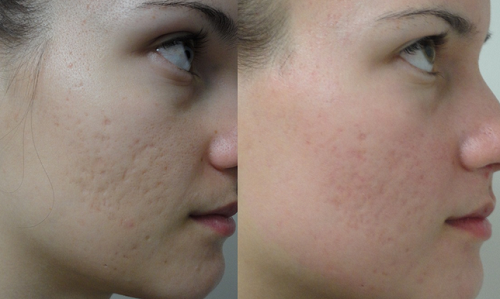 Scar Esthetique điều trị sẹo hiệu quả |(tùy theo cơ địa của mỗi người) Scar Esthetique điều trị sẹo hiệu quả |(tùy theo cơ địa của mỗi người)