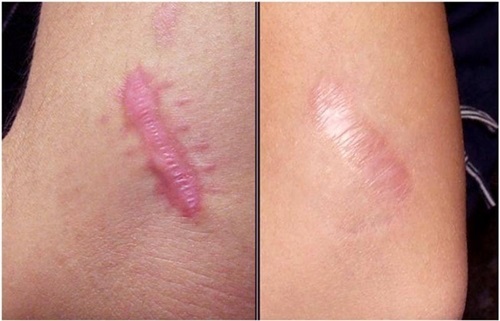 Scar Esthetique trị sẹo thâm, sẹo lồi, sẹo lõm hiệu quả, nhanh chóng
