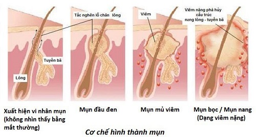 Cơ chế hình thành mụn