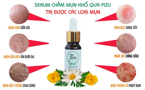Serum trị mụn Pizu là công cụ đắc lực để bạn chống lại mụn. Serum trị mụn Pizu là công cụ đắc lực để bạn chống lại mụn.