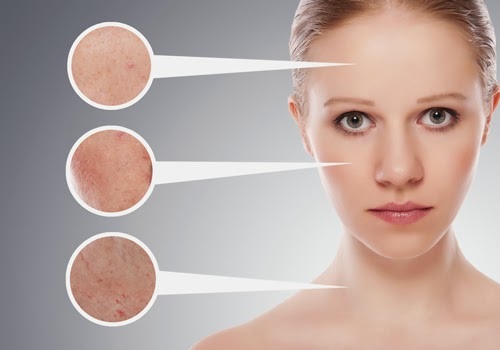 Tùy vào cơ địa của mỗi người mà lựa chọn thuốc bôi trị mụn khác nhau cho phù hợp
