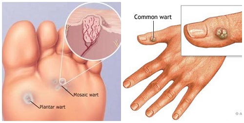 Mụn cóc có thể xuất hiện trên mọi vùng da