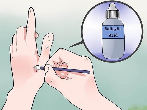 Chấm acid Salicylic là thuốc trị mụn cóc hiệu quả nhất