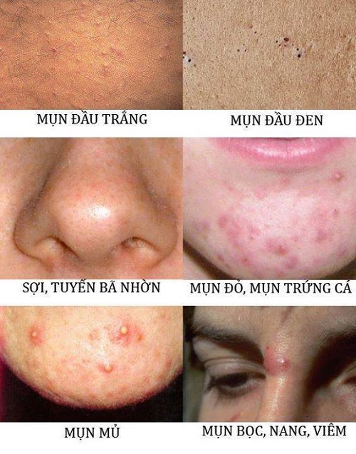 Những loại mụn thường gặp phải
