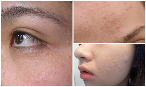 Mụn ẩn rất khó nhìn bằng mắt thường