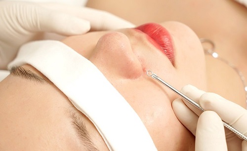 Lấy nhân mụn để loại trừ mụn tận gốc