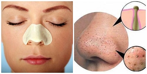Mụn đầu đen khiến cho bạn mất tự tin