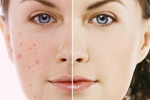 Lựa chọn thuốc trị mụn đúng giúp làn da sạch mụn, mịn màng