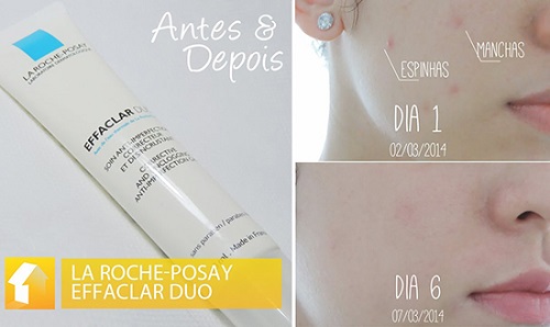 Kem trị mụn La Roche Posay Effaclar giúp trị mụn nhanh chóng