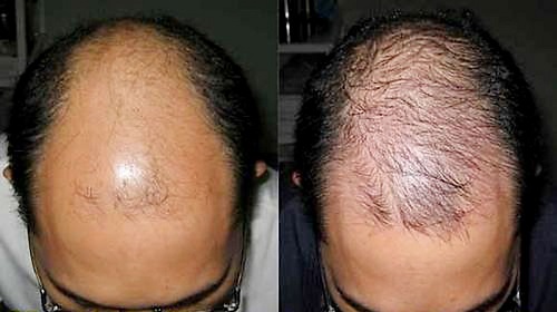 hình ảnh tinh chất hà thủ ô kích thích mọc tóc kim quan