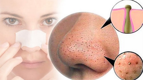 Mụn đầu đen khiến khuôn mặt mất thẩm mỹ, thiếu tự tin