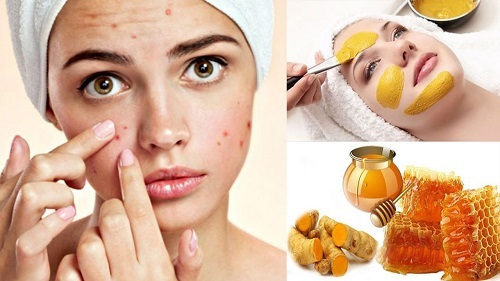 Trị mụn thâm hiệu quả với mật ong