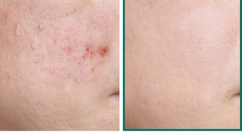 Xà phòng trị mụn Some By Me giúp loại bỏ mụn dễ dàng Xà phòng trị mụn Some By Me giúp loại bỏ mụn dễ dàng