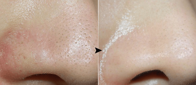 Lỗ chân lông to không còn là vấn đề với vài giọt AHA-BHA-PHA 30 Days Miracle serum