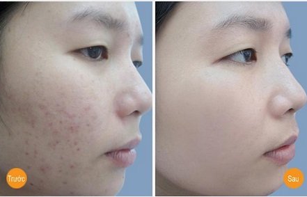 Sẹo mụn cũng được loại bỏ một cách nhẹ nhàng